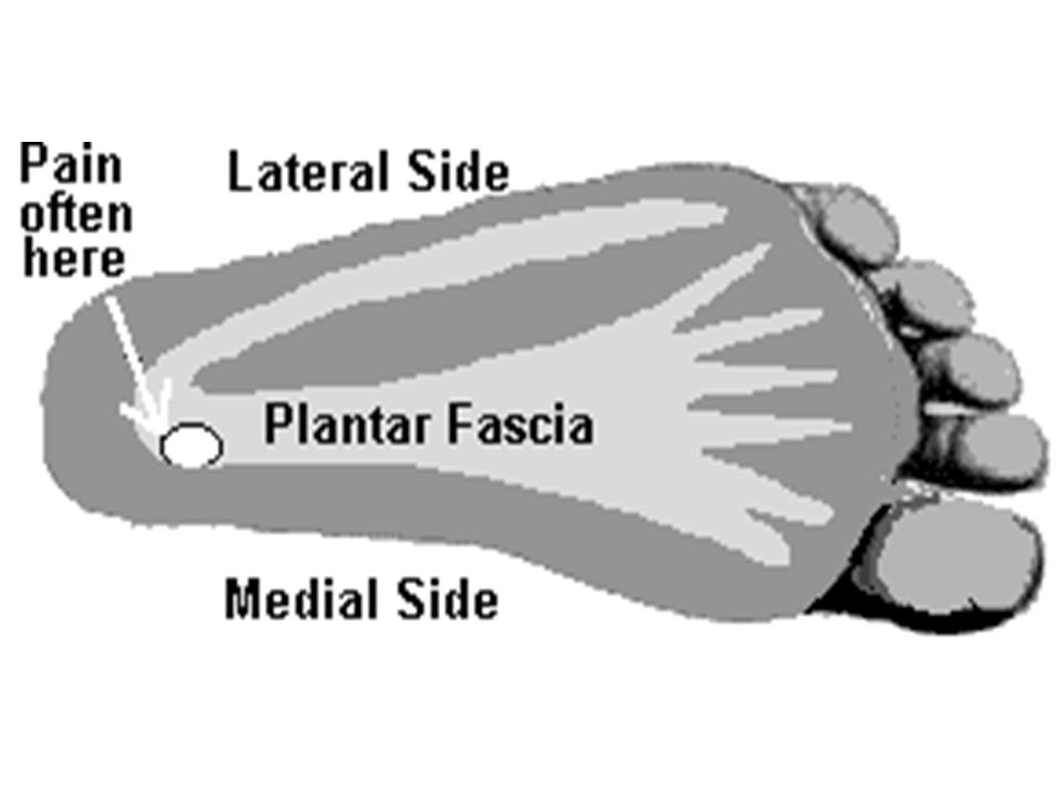 Acupuncture for Plantar Fasciitis: Does it Help? - Inner Gate