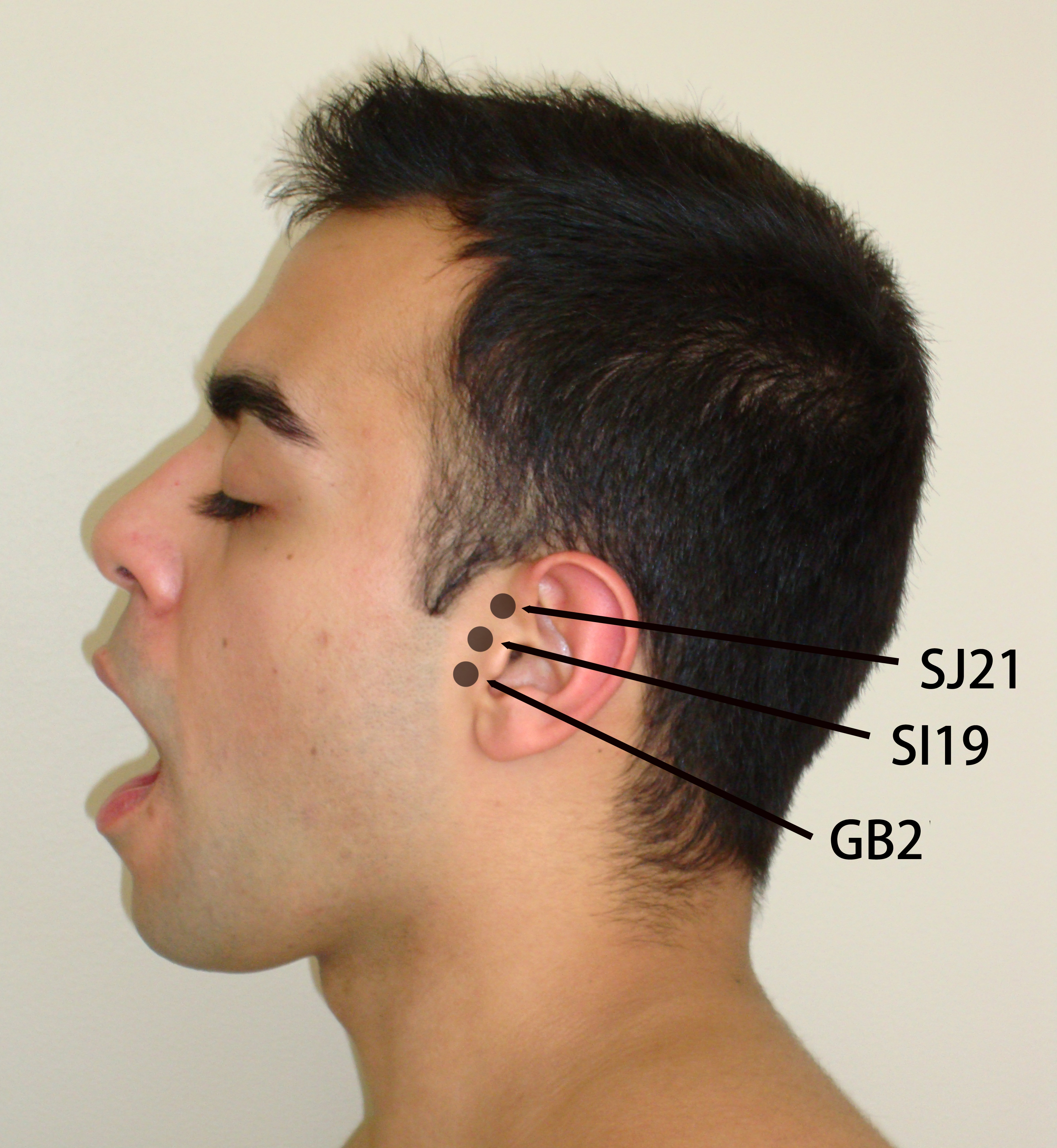 Acupuncture for Tinnitus | Tinnitus Relief | AZ Meraki