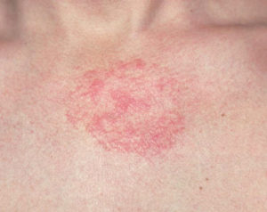 Pic 7 Seborrheic dermatitis
