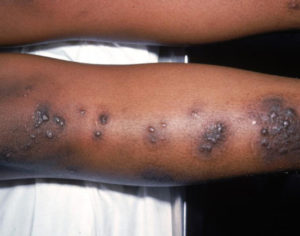 Pic 8 Nummular eczema