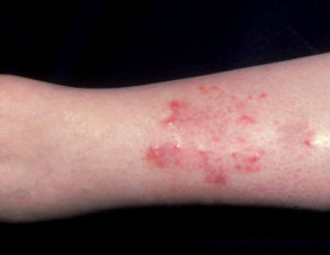 Pic 9 stasis eczema