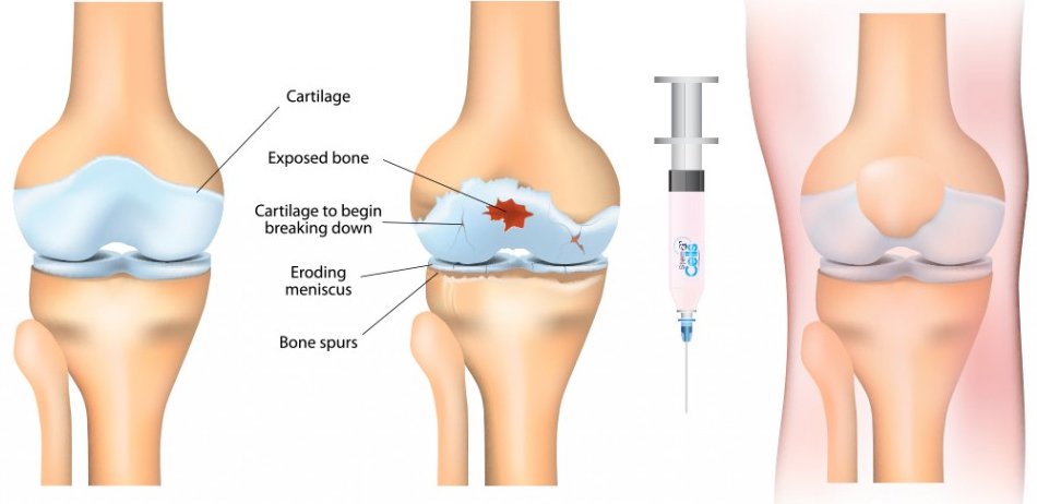 Knee PRP injection